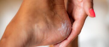 pieds secs et abimés